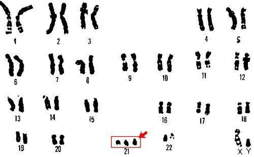 Cromossomo 21 extra, o causador da Síndrome de Down