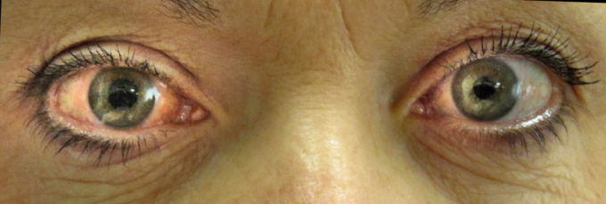 Paciente com glaucoma no olho direito; note como a pupila reage à luz em relação ao olho esquerdo (Crédito: James Heilman/Wikimedia Commons) / visão