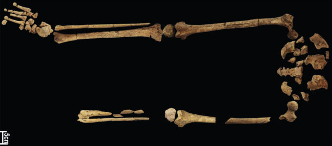 Esqueleto encontrado em Bornéu mostra procedimento de amputação, cicatrização e cura do osso, mas nenhum sinal de inflamação (Crédito: T. Malone et al/Griffith University/Nature Research/Springer Nature)