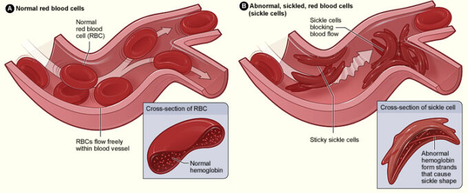 Diferença entre glóbulos vermelhos saudáveis e os de um paciente com anemia falciforme (Crédito: The National Heart, Lung, and Blood Institute)/crispr