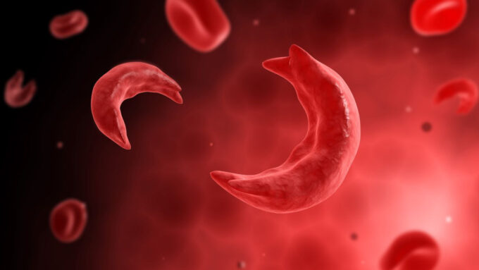 Representação artística de glóbulo vermelho em forma de foice (ao fundo, glóbulos normais), presentes em pacientes com anemia falciforme (Crédito: Stocktrek Images/Getty Images)