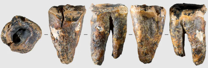 Dente de neandertal encontrado na Sibéria foi claramente escavado (Crédito: Zubova et al., 2026, PLOS One, CC-BY 4.0)