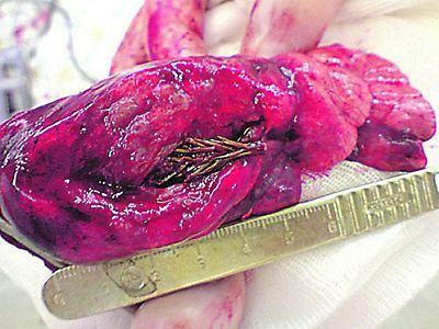 Imagem da planta grudada no pulmão humano.